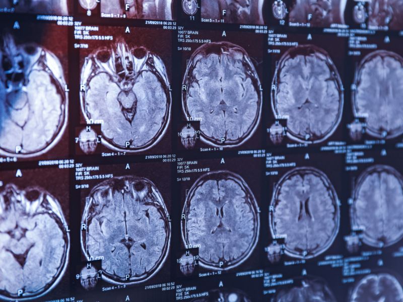 Understanding Concussions and Traumatic Brain Injuries (TBI)